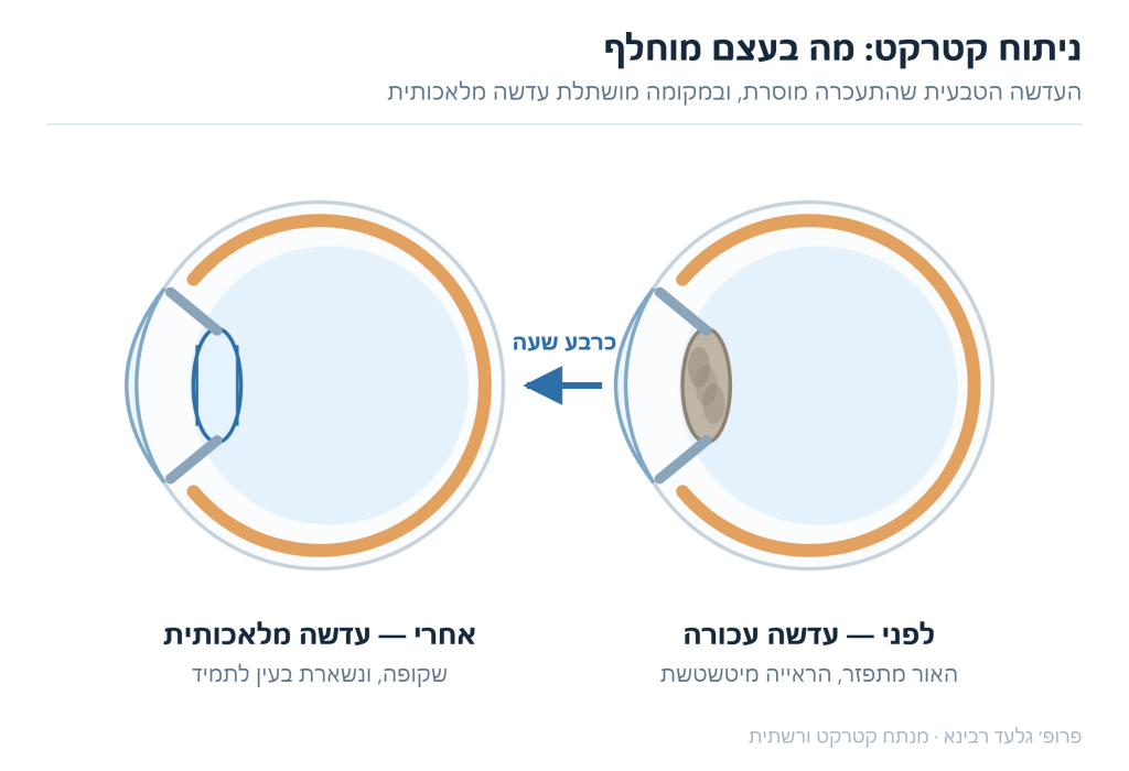 איור השוואה — עדשה טבעית עכורה לפני ניתוח קטרקט מול עדשה מלאכותית שקופה אחריו